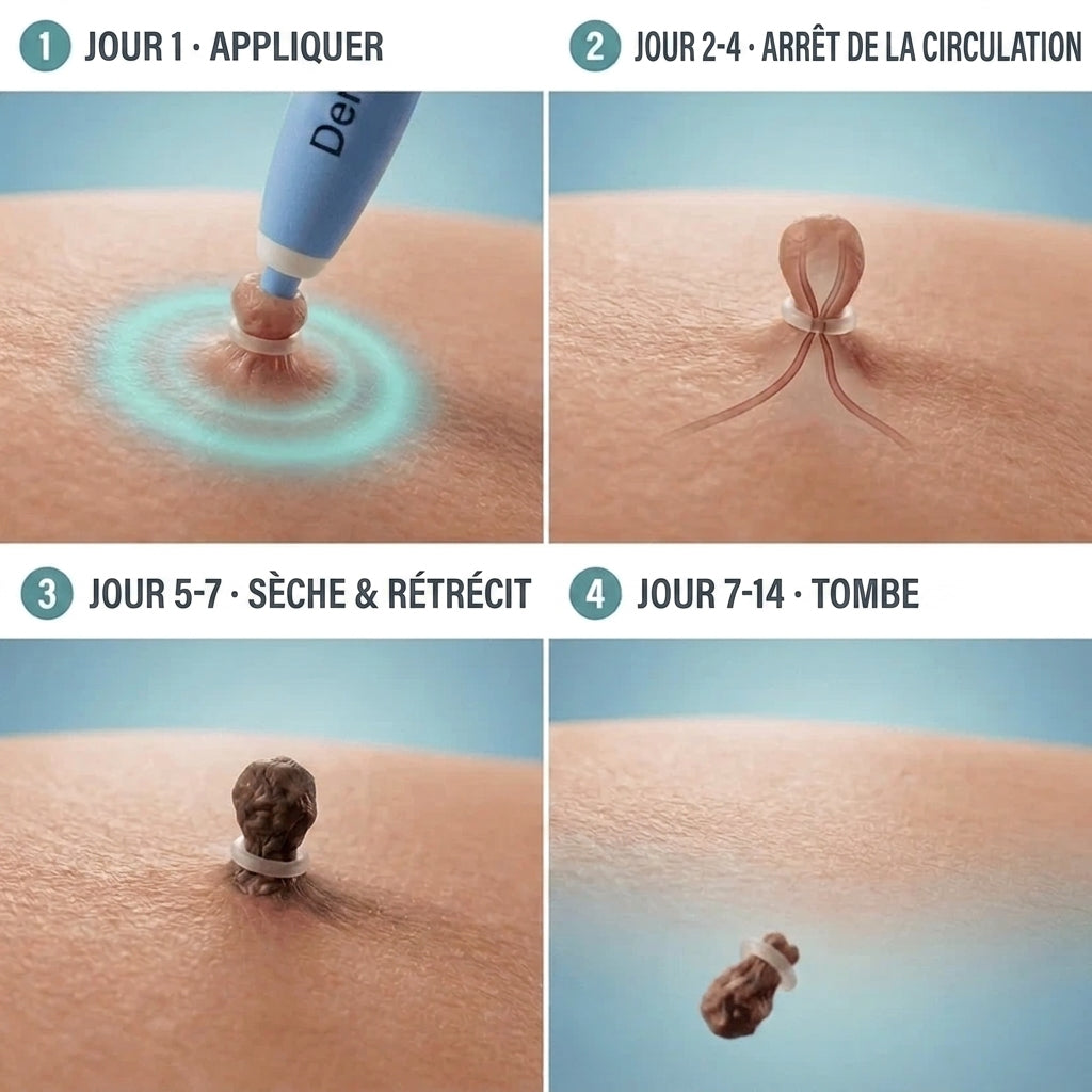 DERMYSS — Kit d’élimination des verrues sans douleur